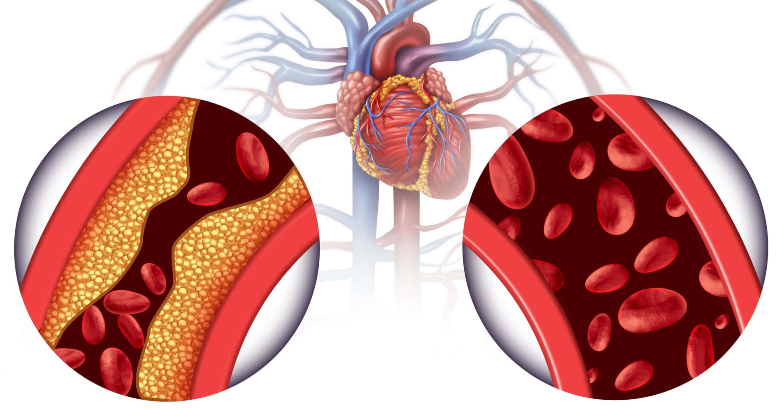 nők szívbetegsége szívkoszorúér-betegségek